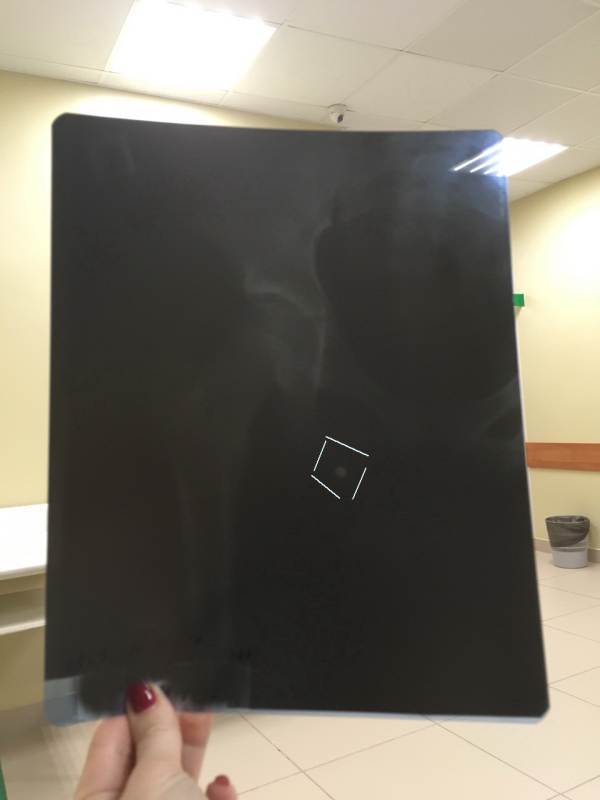Рентгеновский снимок. Пуля (обведено белым) осталась в теле ребёнка